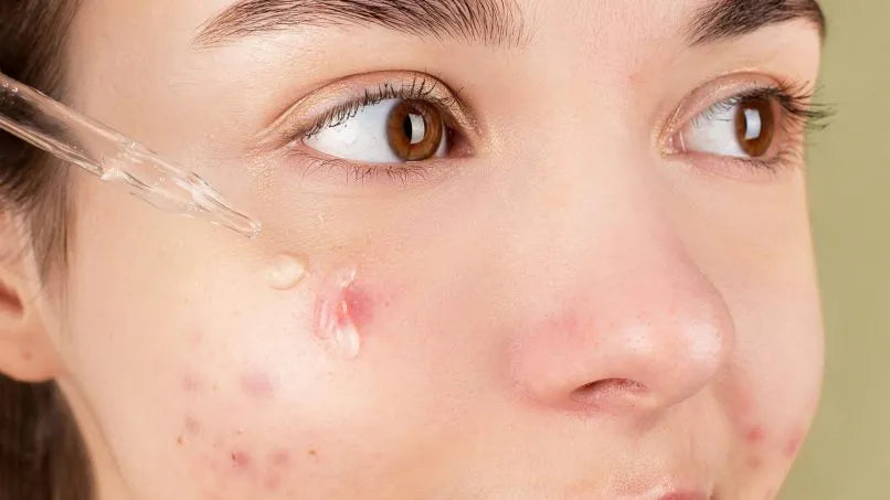Fading the Spots: The Real Truth About Dark Marks and How to Get Rid of Them